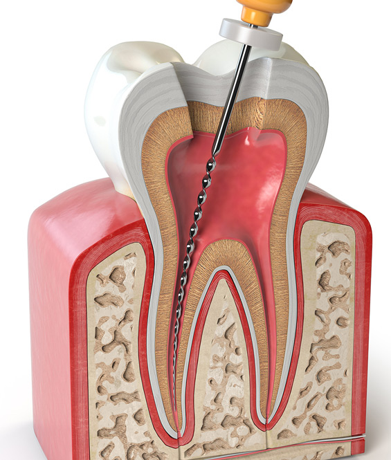 Diagram of inside of tooth having root canal treatment
